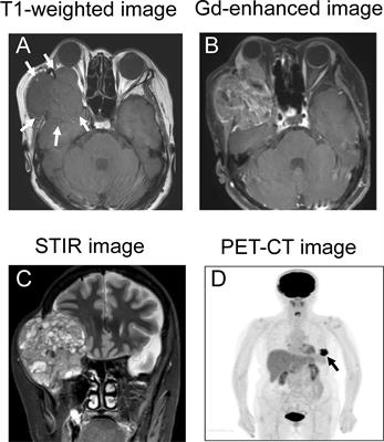 Metastatic Orbital Tumor From Breast Ductal Carcinoma With Neuroendocrine Differentiation Initially Presenting as Ocular Symptoms: A Case Report and Literature Review